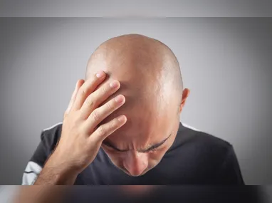 Imagem ilustrativa da imagem Pessoas carecas e calvas precisam passar protetor solar na cabeça? Veja orientação