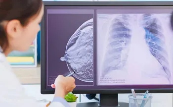 Imagem ilustrativa da imagem IA já ajuda médicos na detecção do câncer de mama