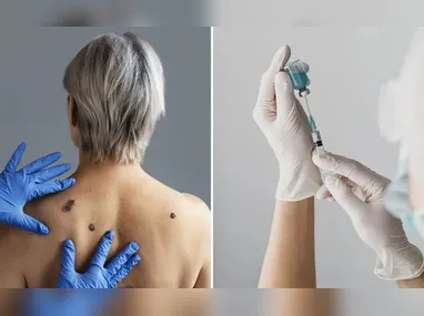 Imagem ilustrativa da imagem Câncer de pele: vacina reduz em até 42% o risco de morte, diz estudo