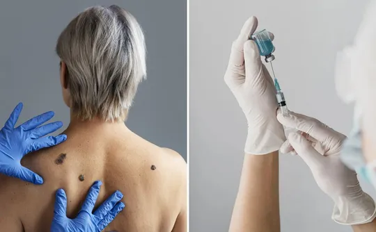 Imagem ilustrativa da imagem Câncer de pele: vacina reduz em até 42% o risco de morte, diz estudo
