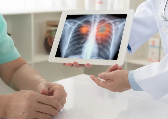 Imagem ilustrativa da imagem Anvisa aprova novo medicamento para câncer de pulmão avançado