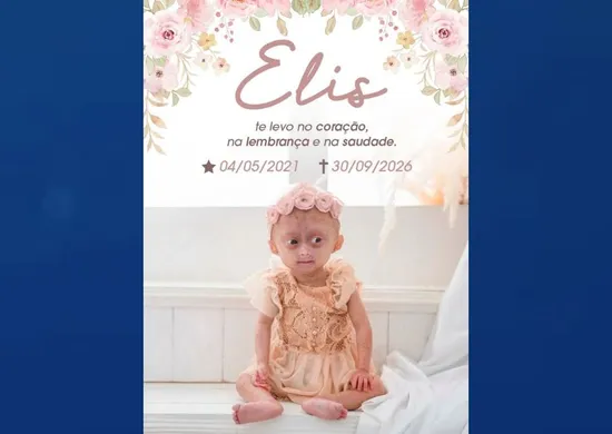 Imagem ilustrativa da imagem Morre Elis, gêmea com síndrome de envelhecimento precoce; entenda a doença