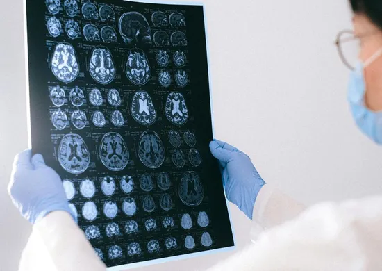 Imagem ilustrativa da imagem Pesquisadores desenvolvem método para prever Alzheimer antes dos primeiros sinais