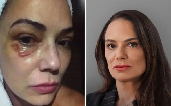 Imagem ilustrativa da imagem Luiza Brunet comenta indenização de R$ 150 mil por agressão de ex