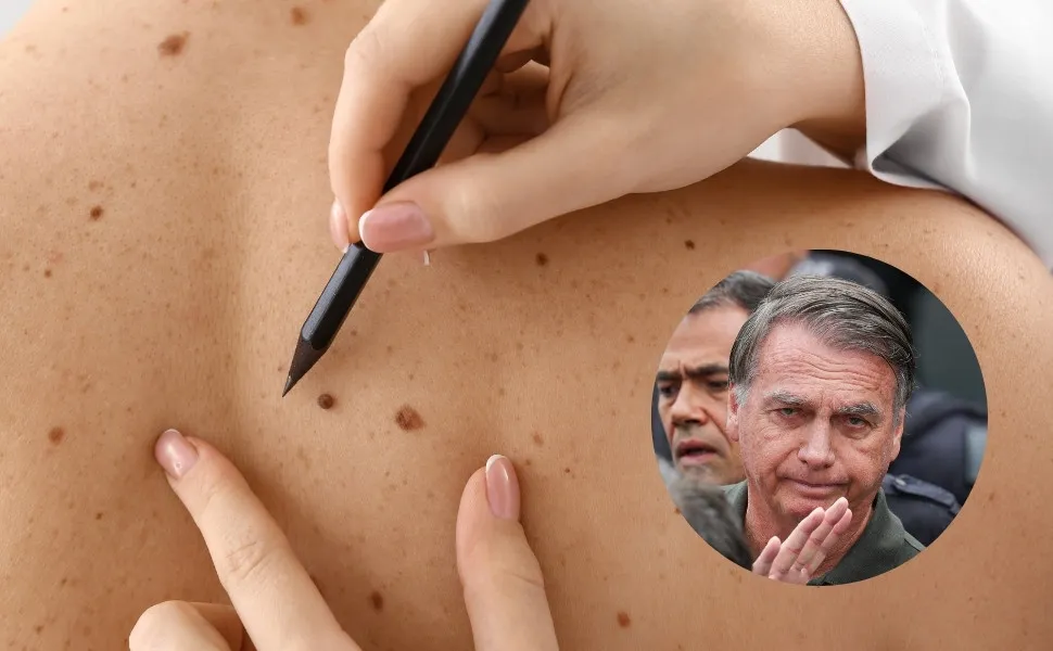 Imagem ilustrativa da imagem Câncer de pele de Bolsonaro é agressivo? Conheça características da doença