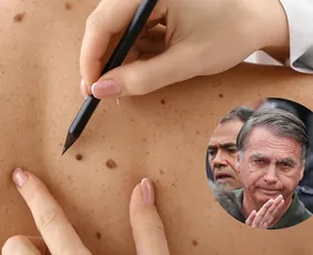 Imagem ilustrativa da imagem Câncer de pele de Bolsonaro é agressivo? Conheça características da doença