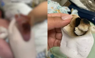 Imagem ilustrativa da imagem Funcionários são afastados após bebê ter pé queimado em hospital na Serra