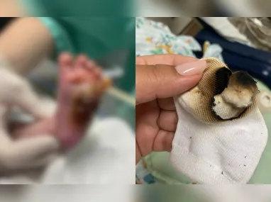Recém-nascido sofreu queimaduras de terceiro grau no pé