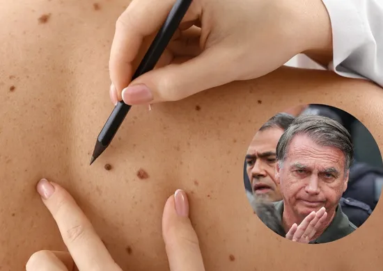 Imagem ilustrativa da imagem Câncer de pele de Bolsonaro é agressivo? Conheça características da doença