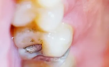 Imagem ilustrativa da imagem Brasil vai parar de usar restaurações prateadas de amálgama nos dentes