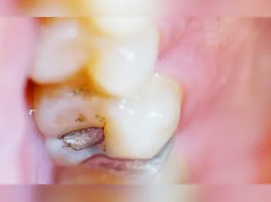 Imagem ilustrativa da imagem Brasil vai parar de usar restaurações prateadas de amálgama nos dentes