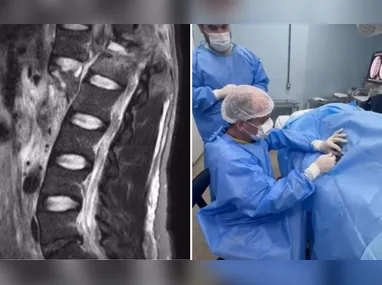 Imagem ilustrativa da imagem Paciente do ES que recebeu polilaminina mostra sensibilidade nas pernas