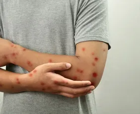 Imagem ilustrativa da imagem Casos de mpox mais que dobram em 20 dias, com 129 confirmações no Brasil