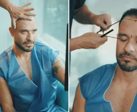 Imagem ilustrativa da imagem Diogo Nogueira faz novo transplante capilar