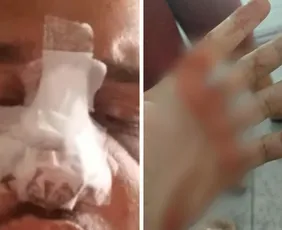 Imagem ilustrativa da imagem Jovem tem nariz quebrado após agressão dentro de coletivo em Vila Velha
