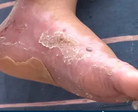 Imagem ilustrativa da imagem Pais acusam negligência em atendimento à criança com queimaduras nos pés