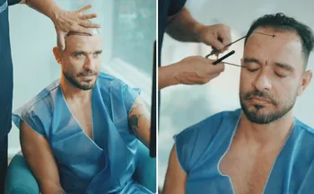 Imagem ilustrativa da imagem Diogo Nogueira faz novo transplante capilar