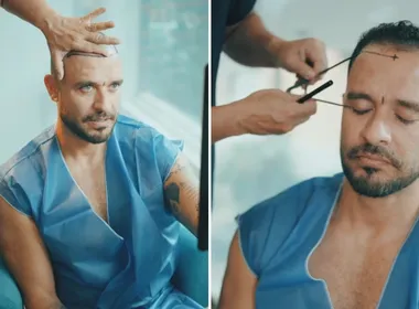 Imagem ilustrativa da imagem Diogo Nogueira faz novo transplante capilar