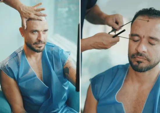 Imagem ilustrativa da imagem Diogo Nogueira faz novo transplante capilar