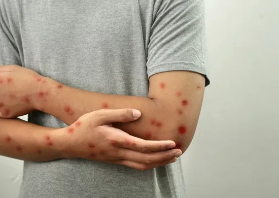 Imagem ilustrativa da imagem Morador de Colatina é o primeiro caso confirmado de mpox em 2026 no ES