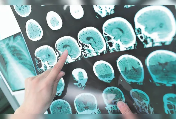 A trombectomia mecânica, para tratamento do AVC isquêmico, ganhou força após 2015, consolidando-se como padrão-ouro para os casos.