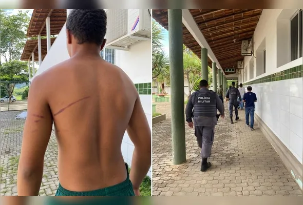 Aluno do Ifes mostra as marcas da agressão que sofreu. Polícia foi acionada e o caso está sendo investigado pela  Delegacia Especializada de Proteção à Criança, ao Adolescente e ao Idoso de Colatina