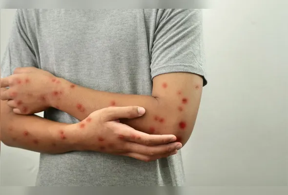 Imagem ilustrativa da imagem Morador de Colatina é o primeiro caso confirmado de mpox em 2026 no ES