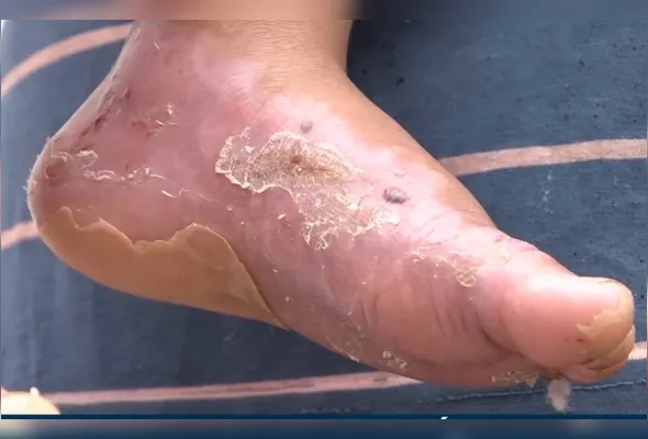 Pé da criança queimado