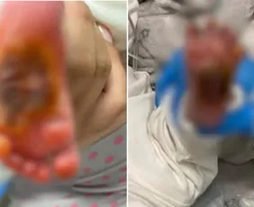 Imagem ilustrativa da imagem Bebê que teve pé queimado em maternidade da Serra tem cirurgia cancelada