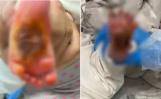 Imagem ilustrativa da imagem Bebê que teve pé queimado em maternidade da Serra tem cirurgia cancelada