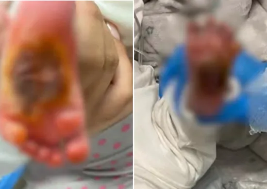 Imagem ilustrativa da imagem Bebê que teve pé queimado em maternidade da Serra tem cirurgia cancelada