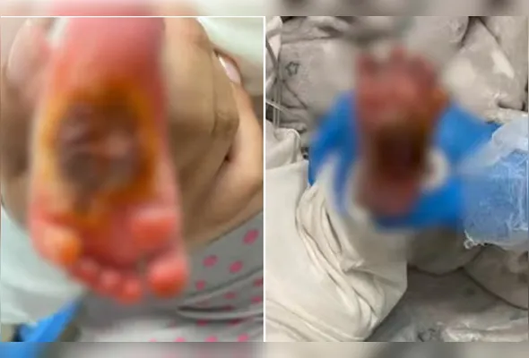 Pé do bebê ficou queimado após entrar em contato com algodão aquecido