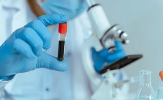 Imagem ilustrativa da imagem Novo exame para diagnosticar Alzheimer chega ao país