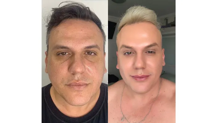 Imagem ilustrativa da imagem Homens procuram especialistas para mudar formato do rosto