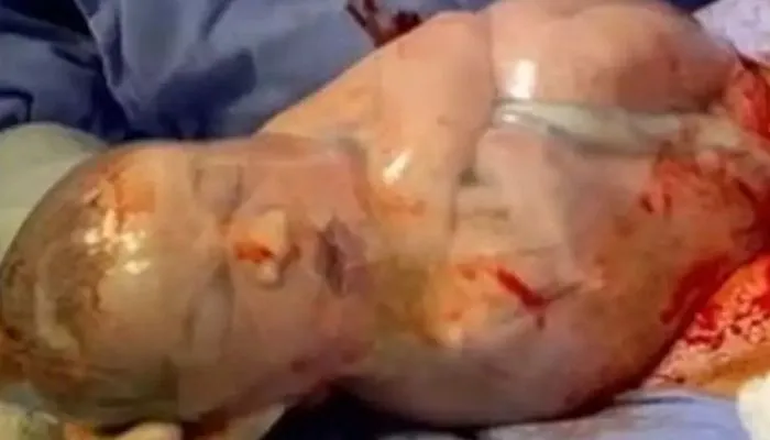 Imagem ilustrativa da imagem Bebê nasce empelicado e vídeo de médico rompendo bolsa viraliza; assista