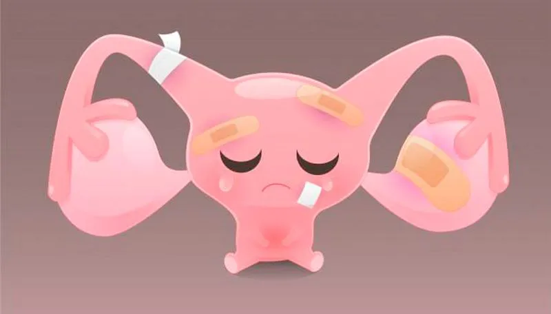 Imagem ilustrativa da imagem Endometriose, além do uso de anticoncepcionais