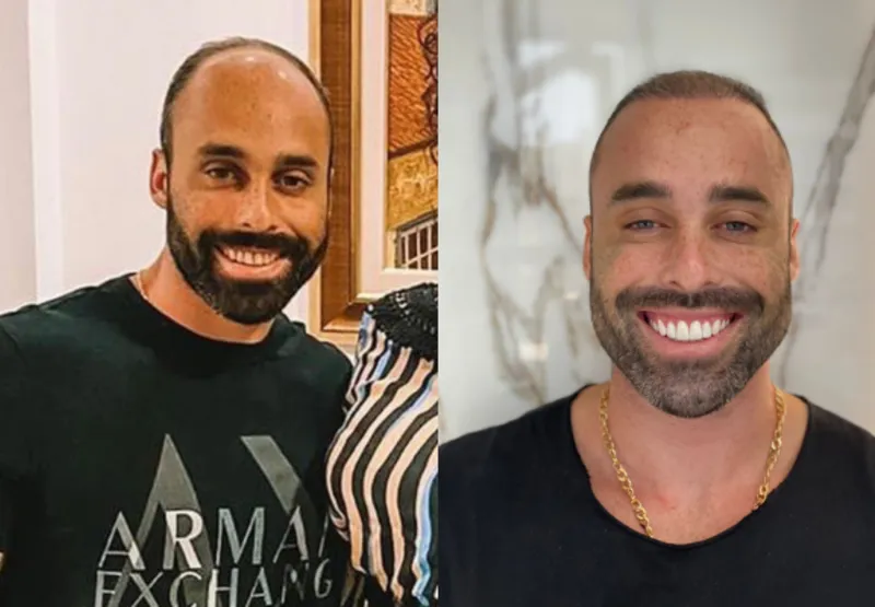 O empresário Igor Rios, 30 anos, optou por fazer uma harmonização facial