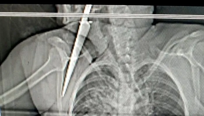 Imagem ilustrativa da imagem Homem é preso por tentar matar a ex-namorada a facadas