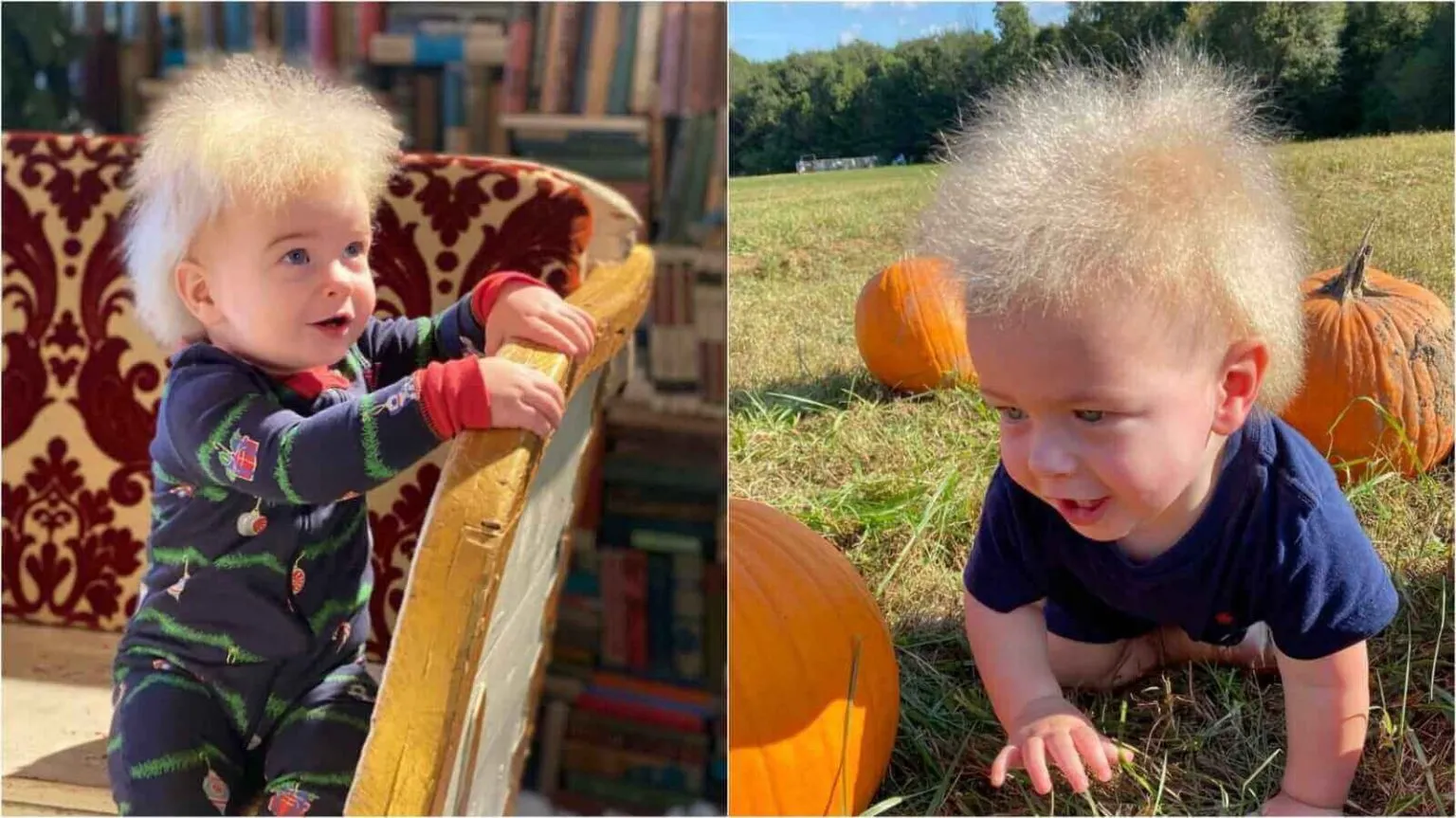 Imagem ilustrativa da imagem Bebê com síndrome rara do 'cabelo impenteável' conquista a internet