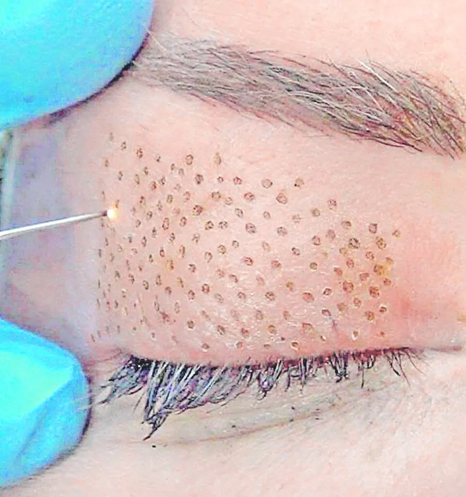 Imagem ilustrativa da imagem Pálpebras bonitas sem cirurgia
