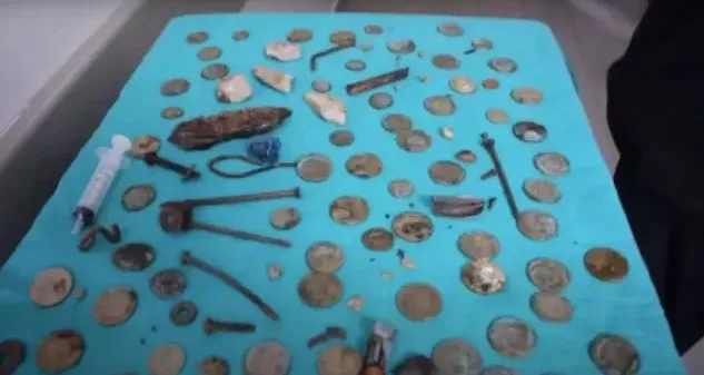 Entre o material encontrado pelos médicos estavam: moedas, baterias, ímãs, pregos, pedaços de vidro, pedras, porcas e parafusos