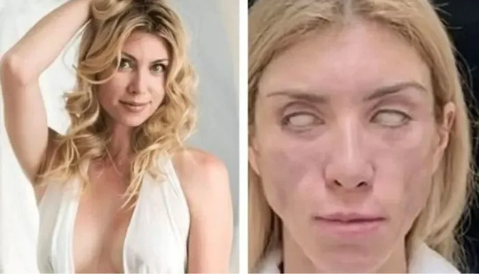 Imagem ilustrativa da imagem Miss gasta quase R$ 20 mil em cirurgia e fica sem sorrir ou fechar os olhos