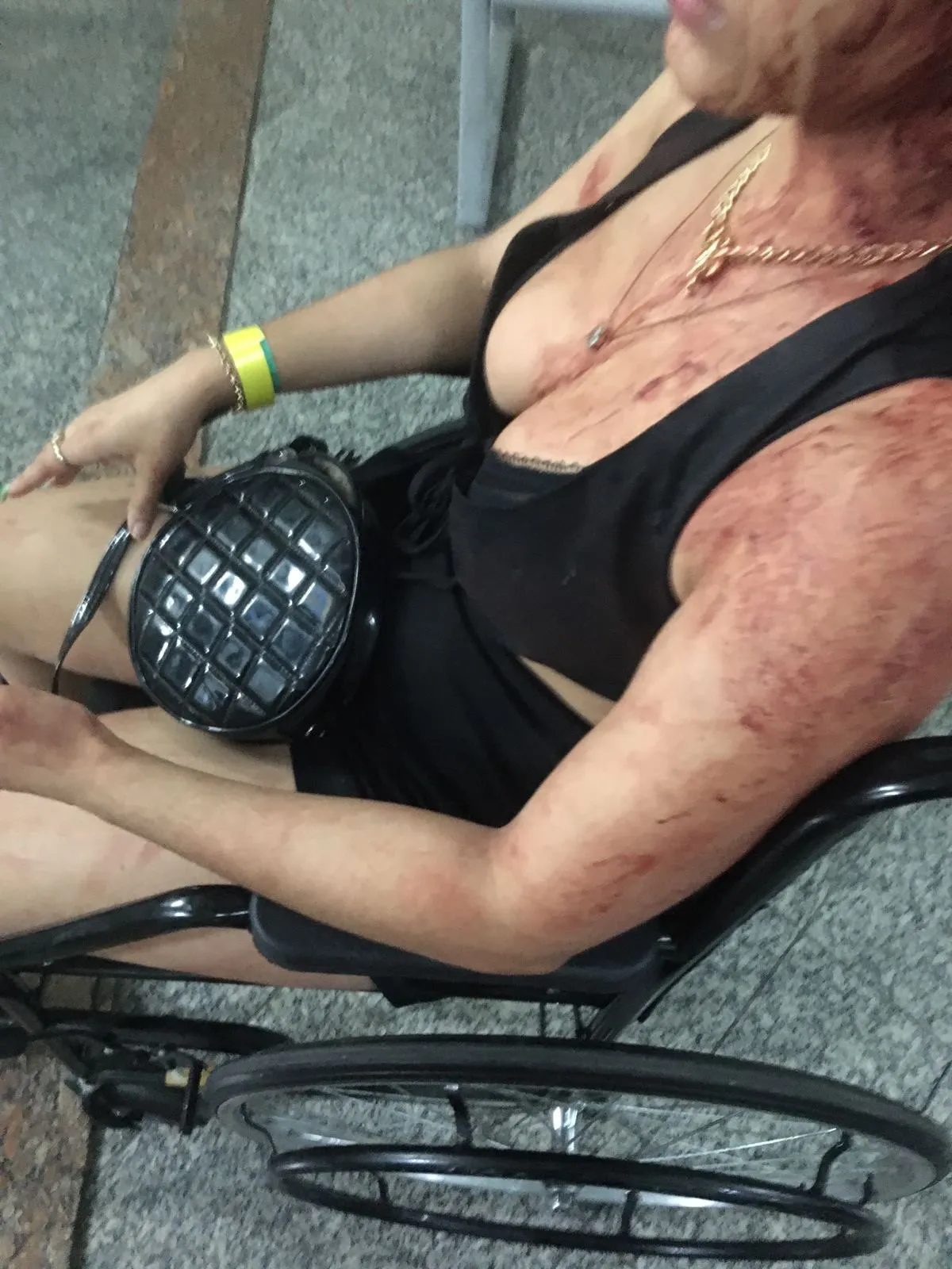Imagem ilustrativa da imagem “Levei uma garrafada por ciúmes”, diz mulher agredida pelo ex-namorado