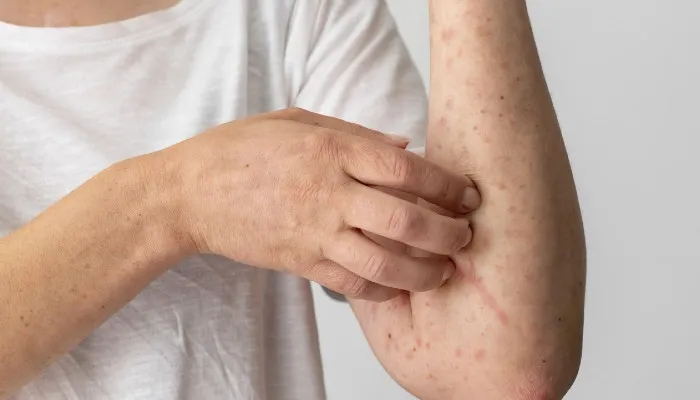 Marcas de varíola no corpo de paciente: principal forma de contágio da doença é no contato pele a pele