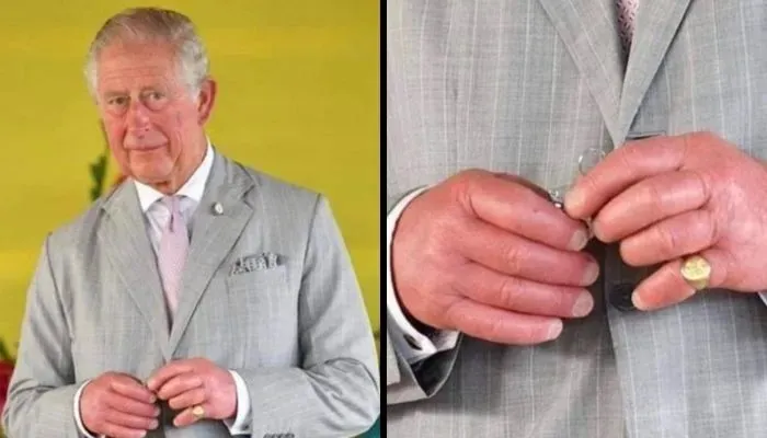 Imagem ilustrativa da imagem Médicos explicam doença nas mãos do Rei Charles III