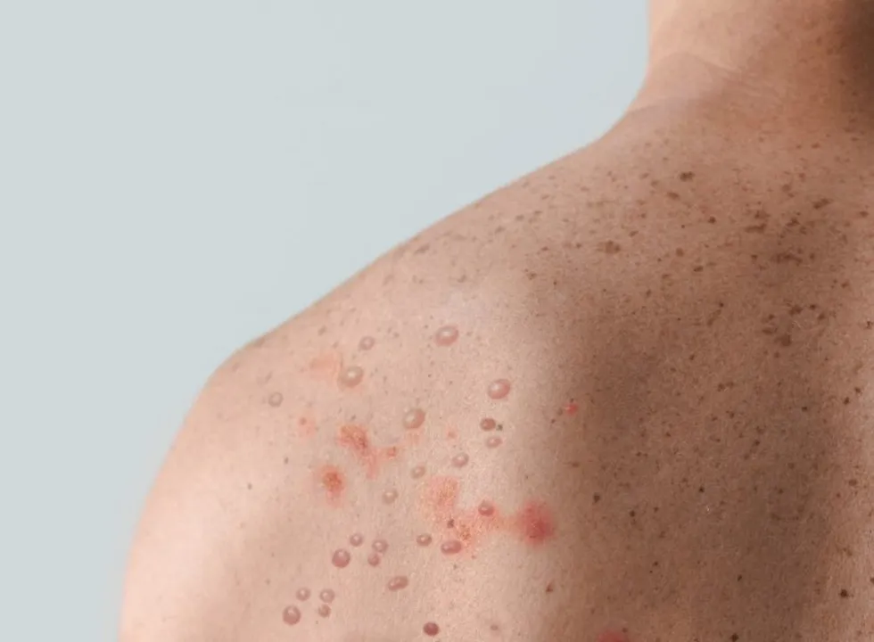 Imagem ilustrativa da imagem Ministro da Saúde diz que Brasil receberá antiviral para combater nova varíola