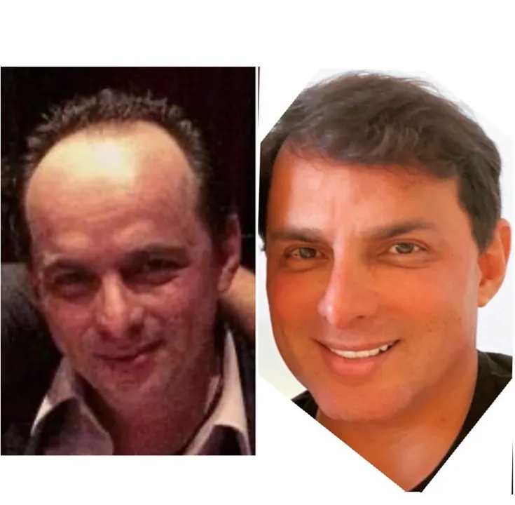 Imagem ilustrativa da imagem Marido de Gretchen surpreende ao mostrar antes e depois da harmonização facial