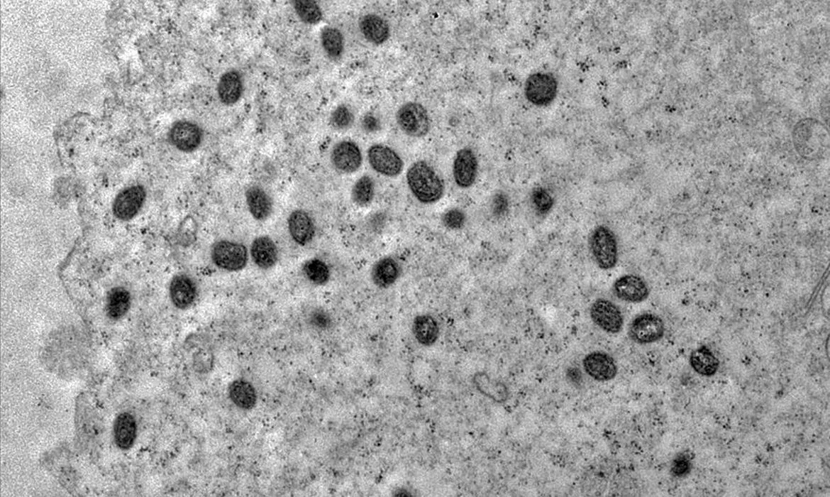 Imagem ilustrativa da imagem Estudo aborda transmissão da nova varíola por superfície contaminada
