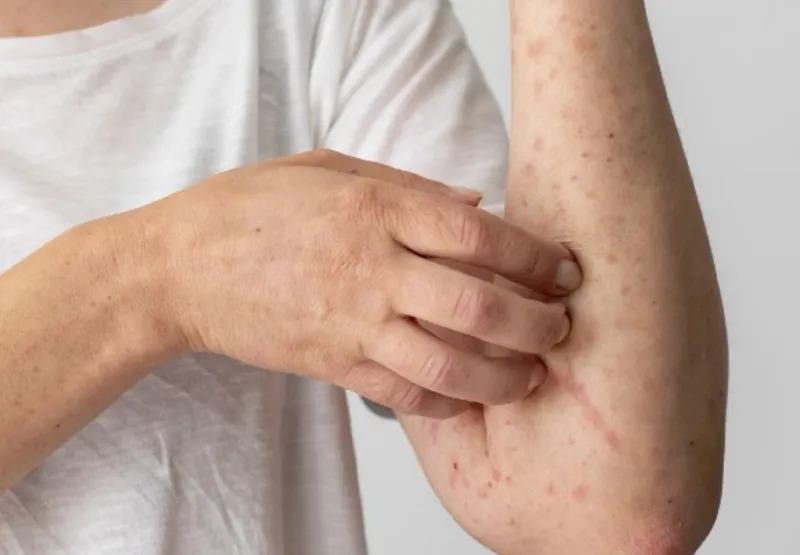 Marcas de varíola no corpo de paciente: principal forma de contágio da doença é no contato pele a pele