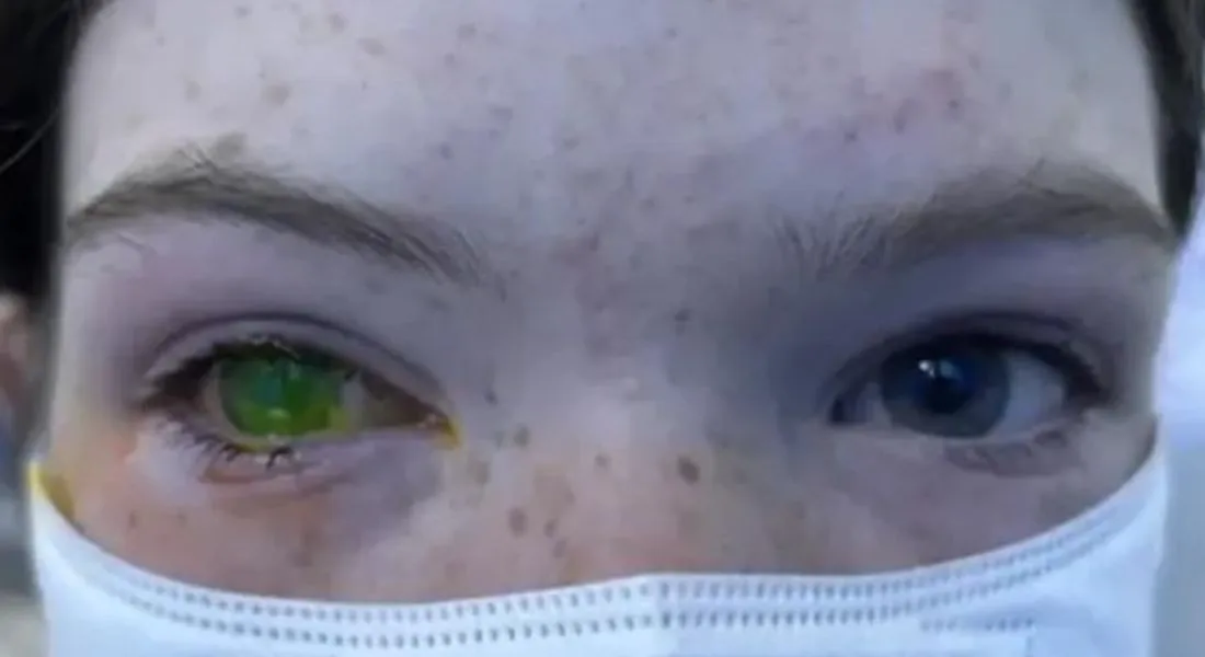 Imagem ilustrativa da imagem Doença causada por besouro muda cor dos olhos e provoca dor extrema